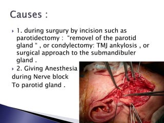  1. during surgury by incision such as
parotidectomy : “removel of the parotid
gland “ , or condylectomy: TMJ ankylosis , or
surgical approach to the submandibuler
gland .
 2. Giving Anesthesia
during Nerve block
To parotid gland .
 