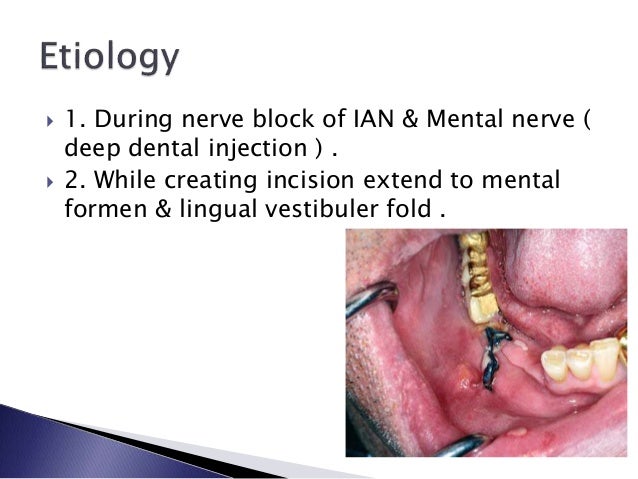 Persistent Pain On The Dento Alveolar Region