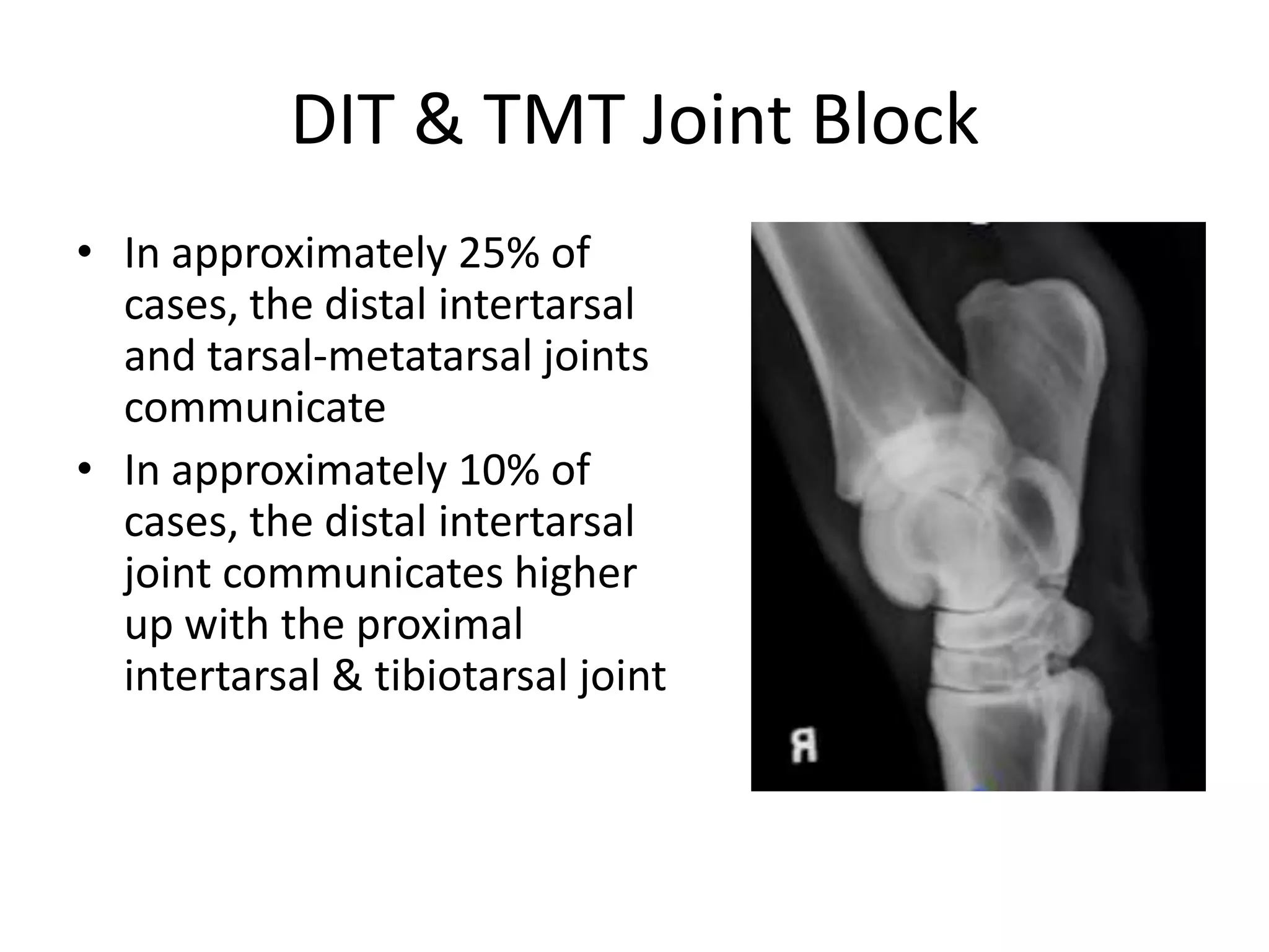 DIT & TMT Joint Block
• In approximately 25% of
cases, the distal intertarsal
and tarsal-metatarsal joints
communicate
• In approximately 10% of
cases, the distal intertarsal
joint communicates higher
up with the proximal
intertarsal & tibiotarsal joint
 
