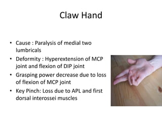Claw Hand
• Cause : Paralysis of medial two
lumbricals
• Deformity : Hyperextension of MCP
joint and flexion of DIP joint
• Grasping power decrease due to loss
of flexion of MCP joint
• Key Pinch: Loss due to APL and first
dorsal interossei muscles
 