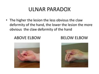ULNAR PARADOX
• The higher the lesion the less obvious the claw
deformity of the hand, the lower the lesion the more
obvious the claw deformity of the hand
ABOVE ELBOW BELOW ELBOW
 