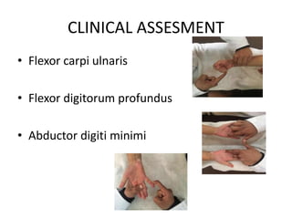 CLINICAL ASSESMENT
• Flexor carpi ulnaris
• Flexor digitorum profundus
• Abductor digiti minimi
 