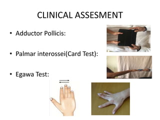 CLINICAL ASSESMENT
• Adductor Pollicis:
• Palmar interossei(Card Test):
• Egawa Test:
 