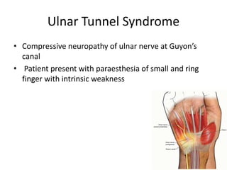 Ulnar Tunnel Syndrome
• Compressive neuropathy of ulnar nerve at Guyon’s
canal
• Patient present with paraesthesia of small and ring
finger with intrinsic weakness
 