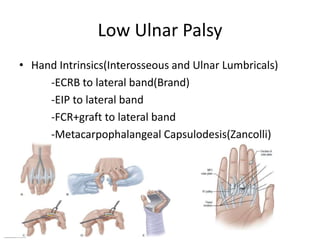 Low Ulnar Palsy
• Hand Intrinsics(Interosseous and Ulnar Lumbricals)
-ECRB to lateral band(Brand)
-EIP to lateral band
-FCR+graft to lateral band
-Metacarpophalangeal Capsulodesis(Zancolli)
 
