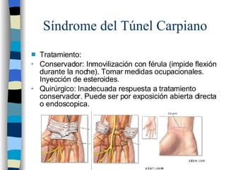 Síndrome del Túnel Carpiano <ul><li>Tratamiento: </li></ul><ul><li>Conservador: Inmovilización con férula (impide flexión ...