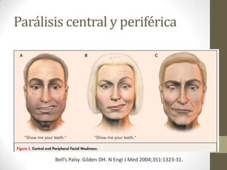 Parálisis central y periférica

Bell’s Palsy. Gilden DH. N Engl J Med 2004;351:1323-31.

 