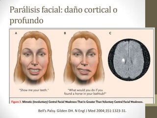 Parálisis facial: daño cortical o
profundo

Bell’s Palsy. Gilden DH. N Engl J Med 2004;351:1323-31.

 