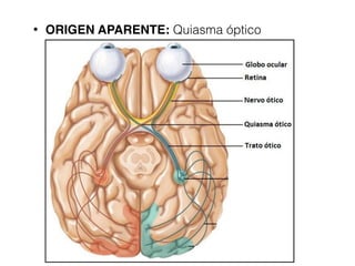 • ORIGEN APARENTE: Quiasma óptico
 