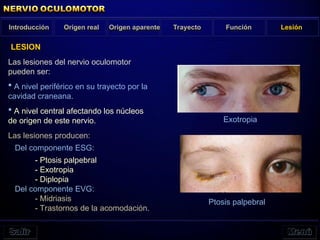 Origen real Origen aparente Función Lesión
Introducción Trayecto
LESION
Las lesiones del nervio oculomotor
pueden ser:
 A nivel periférico en su trayecto por la
cavidad craneana.
 A nivel central afectando los núcleos
de origen de este nervio.
Las lesiones producen:
Del componente ESG:
- Ptosis palpebral
- Exotropia
- Diplopia
Del componente EVG:
- Midriasis
- Trastornos de la acomodación.
Exotropia
Ptosis palpebral
 