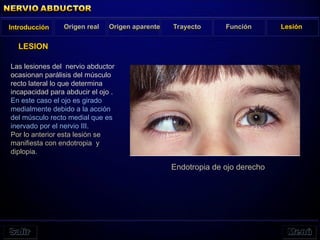 Las lesiones del nervio abductor
ocasionan parálisis del músculo
recto lateral lo que determina
incapacidad para abducir el ojo .
En este caso el ojo es girado
medialmente debido a la acción
del músculo recto medial que es
inervado por el nervio III.
Por lo anterior esta lesión se
manifiesta con endotropia y
diplopia.
LESION
Introducción Origen real Origen aparente Trayecto Función Lesión
Endotropia de ojo derecho
 