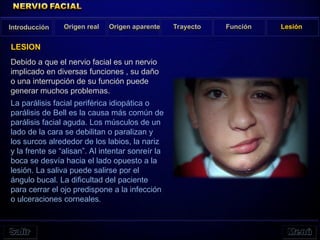 Debido a que el nervio facial es un nervio
implicado en diversas funciones , su daño
o una interrupción de su función puede
generar muchos problemas.
La parálisis facial periférica idiopática o
parálisis de Bell es la causa más común de
parálisis facial aguda. Los músculos de un
lado de la cara se debilitan o paralizan y
los surcos alrededor de los labios, la nariz
y la frente se “alisan”. Al intentar sonreír la
boca se desvía hacia el lado opuesto a la
lesión. La saliva puede salirse por el
ángulo bucal. La dificultad del paciente
para cerrar el ojo predispone a la infección
o ulceraciones corneales.
Origen real Origen aparente Trayecto Función Lesión
LESION
Introducción
 