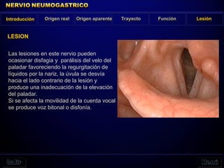 Introducción Origen real Origen aparente Trayecto Función Lesión
LESION
Las lesiones en este nervio pueden
ocasionar disfagia y parálisis del velo del
paladar favoreciendo la regurgitación de
líquidos por la nariz, la úvula se desvía
hacia el lado contrario de la lesión y
produce una inadecuación de la elevación
del paladar.
Si se afecta la movilidad de la cuerda vocal
se produce voz bitonal o disfonía.
 