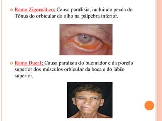  Ramo Zigomático: Causa paralisia, incluindo perda do 
Tônus do orbicular do olho na pálpebra inferior. 
 Ramo Bucal: Causa paralisia do bucinador e da porção 
superior dos músculos orbicular da boca e do lábio 
superior. 
 