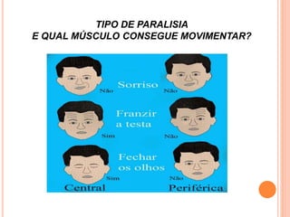 TIPO DE PARALISIA 
E QUAL MÚSCULO CONSEGUE MOVIMENTAR? 
 