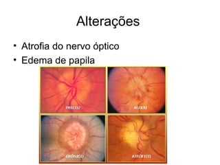 18 
Alterações 
• Atrofia do nervo óptico 
• Edema de papila 
 