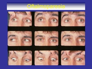 Oftalmoparesia
 