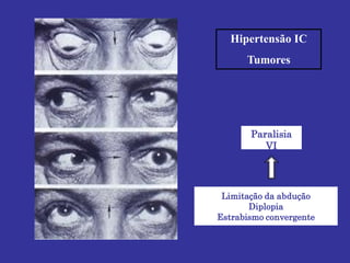 Paralisia
VI
Limitação da abdução
Diplopia
Estrabismo convergente
Hipertensão IC
Tumores
 