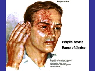 Herpes zoster
Ramo oftálmico
 