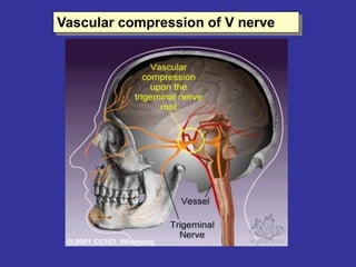 Vascular compression of V nerve
 