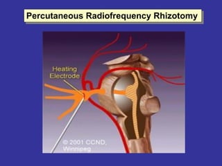 Percutaneous Radiofrequency Rhizotomy
 