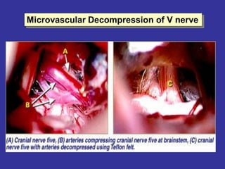 Microvascular Decompression of V nerve
 