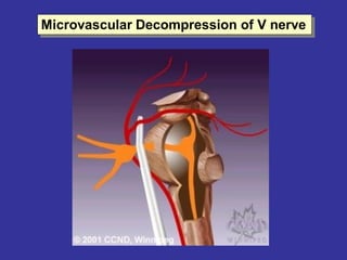 Microvascular Decompression of V nerve
 