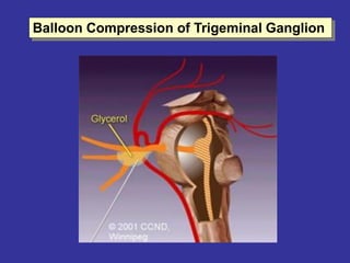 Balloon Compression of Trigeminal Ganglion
 