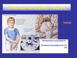 Hemiparesia contralateral
Paralisia homolateral do VI
VII
Síndrome de Millard Gublerd
Tumores
 