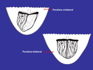 Paralisia unilateral
Paralisia bilateral
 