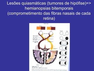 Lesões quiasmáticas (tumores de hipófise)=>
hemianopsias bitemporais
(comprometimento das fibras nasais de cada
retina)
 