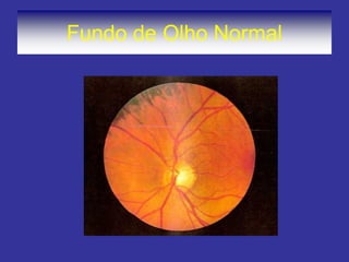 Fundo de Olho Normal
 