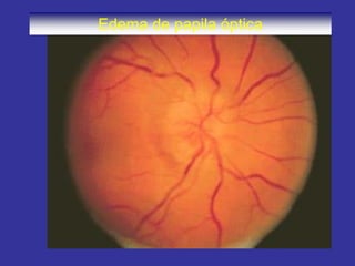 Edema de papila óptica
 