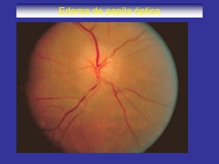 Edema de papila óptica
 