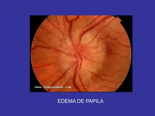 EDEMA DE PAPILA
 