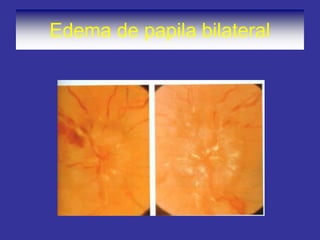 Edema de papila bilateral
 