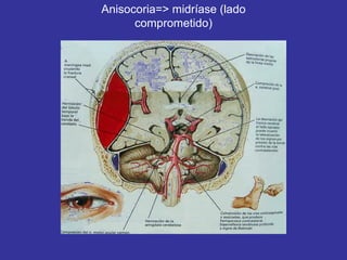 Anisocoria=> midríase (lado
comprometido)
 