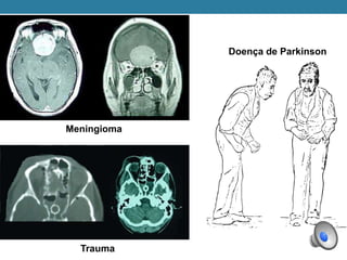 Meningioma
Trauma
Doença de Parkinson
 