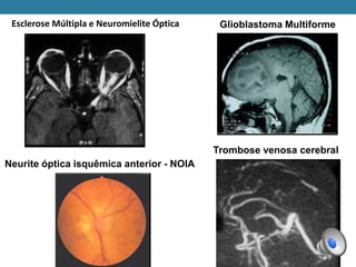 Esclerose Múltipla e Neuromielite Óptica Glioblastoma Multiforme
Trombose venosa cerebral
Neurite óptica isquêmica anterior - NOIA
 