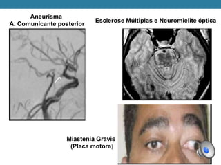 Aneurisma
A. Comunicante posterior
Miastenia Gravis
(Placa motora)
Esclerose Múltiplas e Neuromielite óptica
 