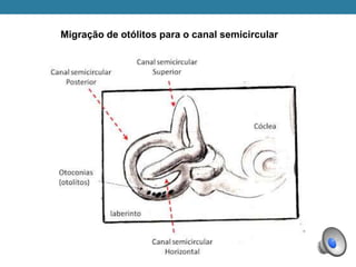 Migração de otólitos para o canal semicircular
 