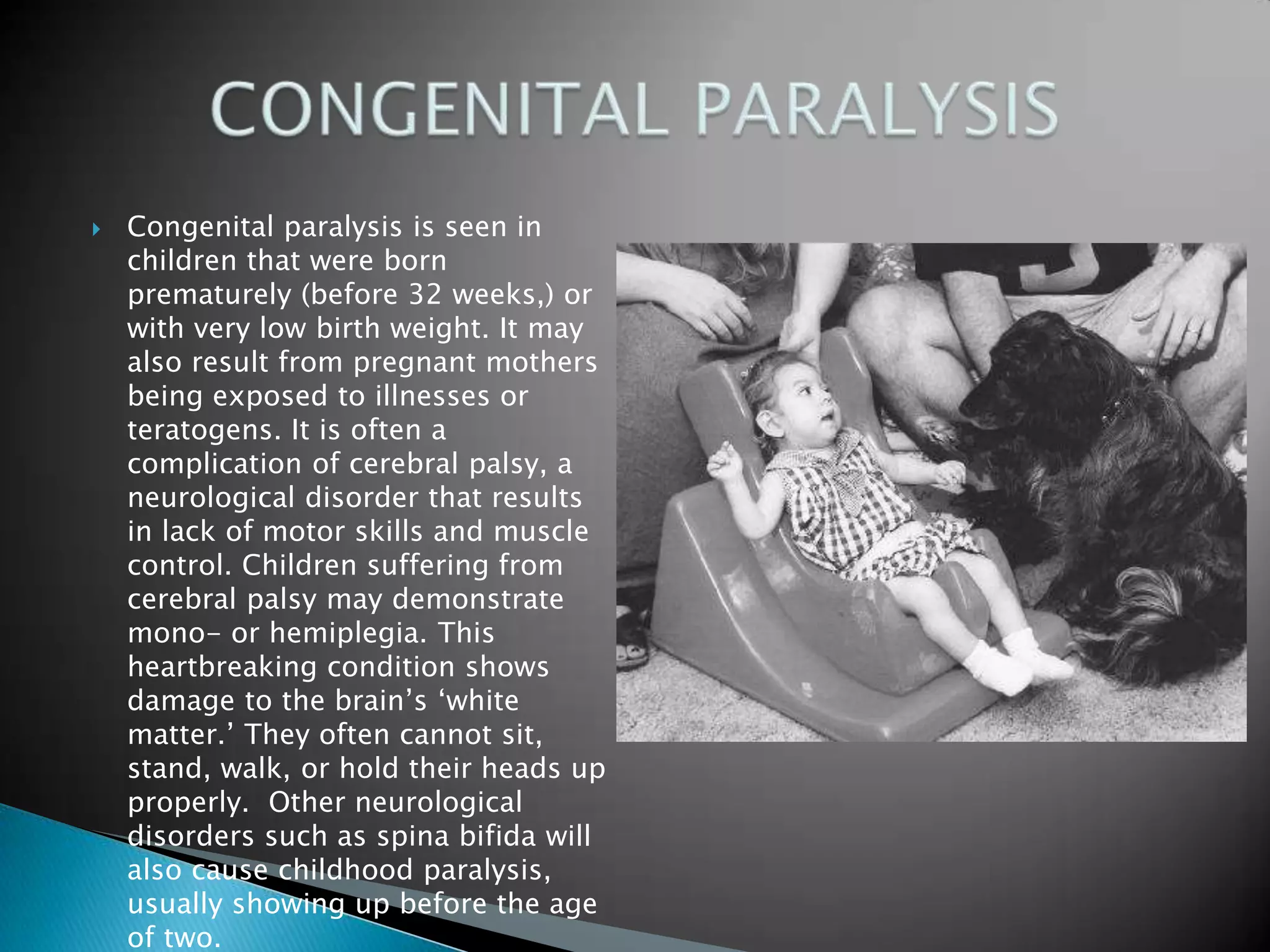 Congenital paralysis is seen in children that were born prematurely (before 32 weeks,) or with very low birth weight. It may also result from pregnant mothers being exposed to illnesses or teratogens. It is often a complication of cerebral palsy, a neurological disorder that results in lack of motor skills and muscle control. Children suffering from cerebral palsy may demonstrate mono- or hemiplegia. This heartbreaking condition shows damage to the brain’s ‘white matter.’ They often cannot sit, stand, walk, or hold their heads up properly.  Other neurological disorders such as spina bifida will also cause childhood paralysis, usually showing up before the age of two. CONGENITAL PARALYSIS