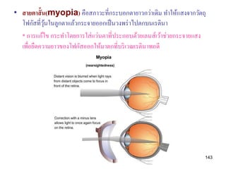 • สายตาสั้ น(myopia) คือสภาวะที่กระบอกตายาวกว่าเดิม ทาให้แสงจากวัตถุ
  โฟกัสที่วนในลูกตาแล้วกระจายออกเป็ นวงพร่ าไปตกบนเรตินา
            ุ้
  * การแก้ไข กระทาโดยการใส่ แว่นตาที่ประกอบด้วยเลนส์เว้าช่วยกระจายแสง
  เพื่อยืดความยาวของโฟกัสออกให้มาตกที่บริ เวณเรตินาพอดี




                                                                    143
 
