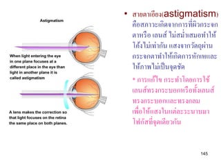• สายตาเอียง(astigmatism)
  คือสภาวะเกิดจากการที่ผวกระจก
                          ิ
  ตาหรื อ เลนส์ ไม่สม่าเสมอทาให้
                             ่
  โค้งไม่เท่ากัน แสงจากวัตถุผาน
  กระจกตาทาให้เกิดการหักเหและ
  ให้ภาพไม่เป็ นจุดชัด
  * การแก้ไข กระทาโดยการใช้
  เลนส์ทรงกระบอกหรื อทั้งเลนส์
  ทรงกระบอกและทรงกลม
  เพื่อให้แสงในแต่ละระนาบมา
  โฟกัสที่จุดเดียวกัน


                         145
 