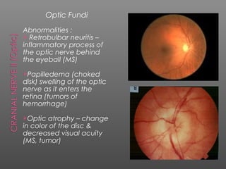 Optic Fundi
Abnormalities :
 Retrobulbar neuritis –
inflammatory process of
the optic nerve behind
the eyeball (MS)

Papilledema    (choked
disk) swelling of the optic
nerve as it enters the
retina (tumors of
hemorrhage)

Optic  atrophy – change
in color of the disc &
decreased visual acuity
(MS, tumor)
 