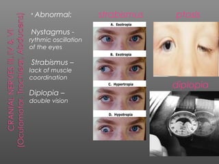 * Abnormal:           strabismus   ptosis
Nystagmus -
rythmic oscillation
of the eyes

Strabismus –
lack of muscle
coordination
                                   diplopia
Diplopia –
double vision
 