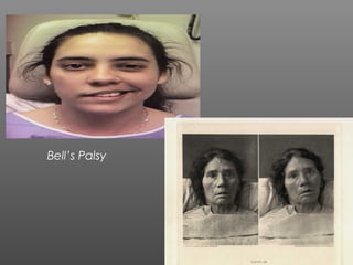 Bell’s Palsy
 