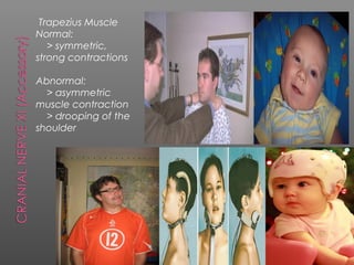 Trapezius Muscle
Normal:
   > symmetric,
strong contractions

Abnormal:
  > asymmetric
muscle contraction
  > drooping of the
shoulder
 
