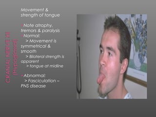 Movement &
strength of tongue

Note    atrophy,
tremors & paralysis
Normal:
   > Movement is
symmetrical &
smooth
   > Bilateral strength is
apparent
  > tongue at midline

Abnormal:
 > Fasciculation –
PNS disease
 