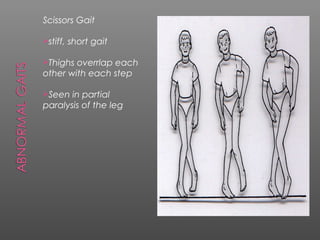 Scissors Gait

stiff,   short gait

Thighs overrlap each
other with each step

Seen  in partial
paralysis of the leg
 